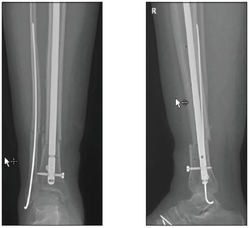 Osteosyntéza hřebem Expert (KÚCH)
