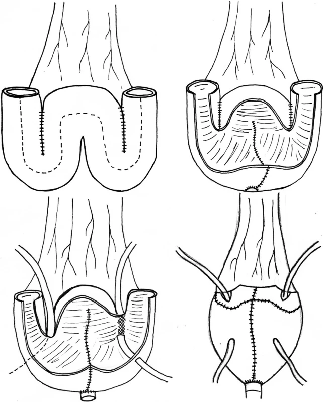 Princip konstrukce ortotopního rezervoáru typu „Mansoura pouch“ (volně podle http://www.urotunisia.com/ biblio/Mansoura/further.htm)
Fig. 1. Construction principles of the “Mansoura pouch“ orthotopic reservoir