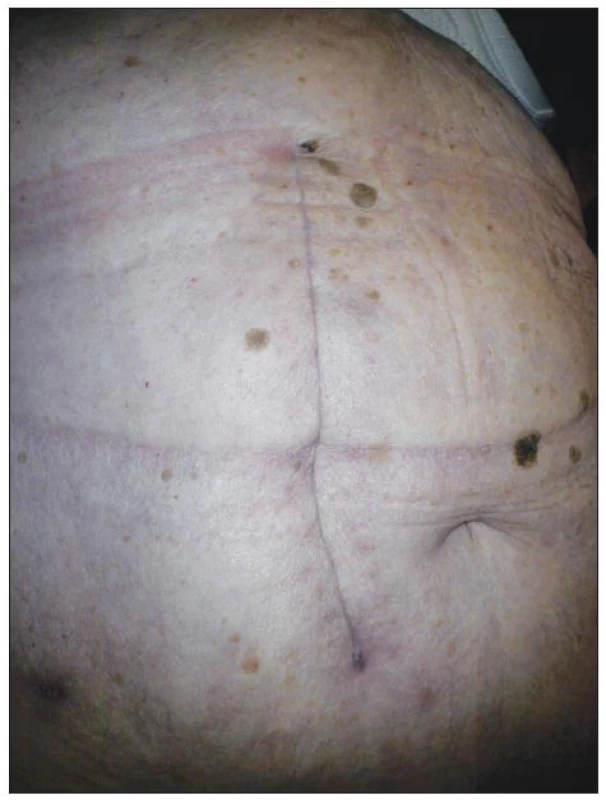 Per primam intentionem zhojená operačná rana po laparotómii (paramediálny transrektálny rez v pravom hypochondriu)
Fig. 5. Per primam intentionem healed laparotomy wound (paramedial transrectal section in the right hypochondrium)
