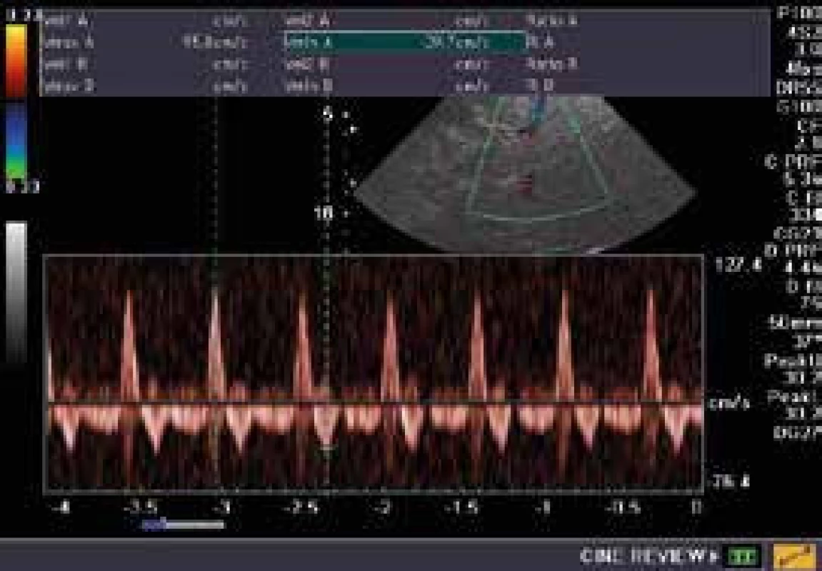 Transkraniální dopplerovská sonografie
u pacientky s klinickým nálezem mozkové
smrti, který byl vzápětí verifikován angiograficky.
V diastole patrný reverzní průtok na
pravé a. cerebri media