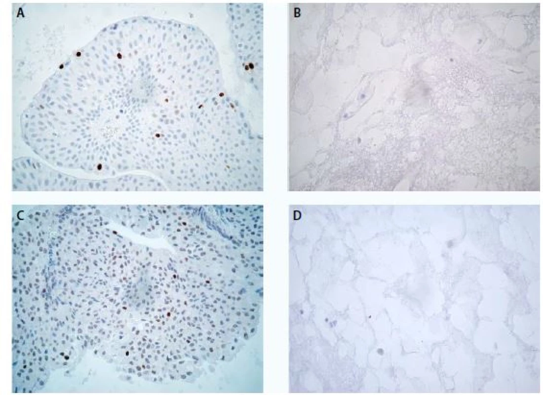 Low-grade uroteliální karcinom, imunochemické vyšetření markeru Ki-67 ve tkáni (A) a v cytobloku (B)
a markeru p53 ve tkáni (C) a v cytobloku (D), zvětšení 400×<br>
Fig. 1. Low-grade urothelial carcinoma, expression of Ki-67 in tissue section (A) and in cell block section (B) and
expression of p53 in tissue section (C) and in cell block section (D), magnification 400×