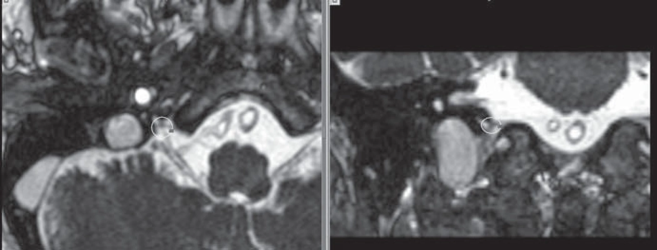 Ozařovací plán pro léčbu glosofaryngeální neuralgie.
Magnetická rezonance v ciss sekvenci, tloušťka řezu 1 mm. Zobrazena 50% isodosa v oblasti výskytu ganglion inferior n. IX. Vlevo axiální, vpravo koronární řezy.
Fig. 1. Irradiation plan for treatment of glossopharyngeal neuralgia.
Magnetic resonance in CISS sequence, slice thickness 1 mm. Showing 50% isodose at the area of inferior ganglion n. IX. Axial slices left, coronal right.