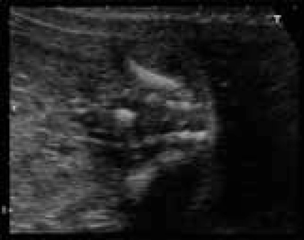 Iliakální úhel ve 2. trimestru.