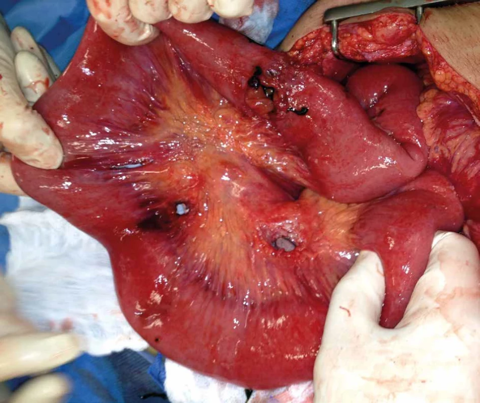 Průstřely tenkého střeva   Fig. 2: Gunshot wounds of the small bowel