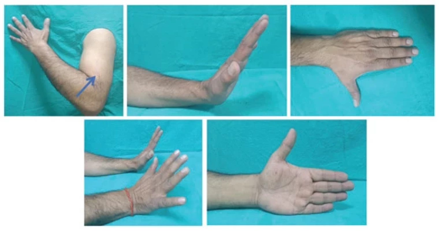 Postoperative outcome at 6 months showing complete preservation of wrist and fi nger extension.