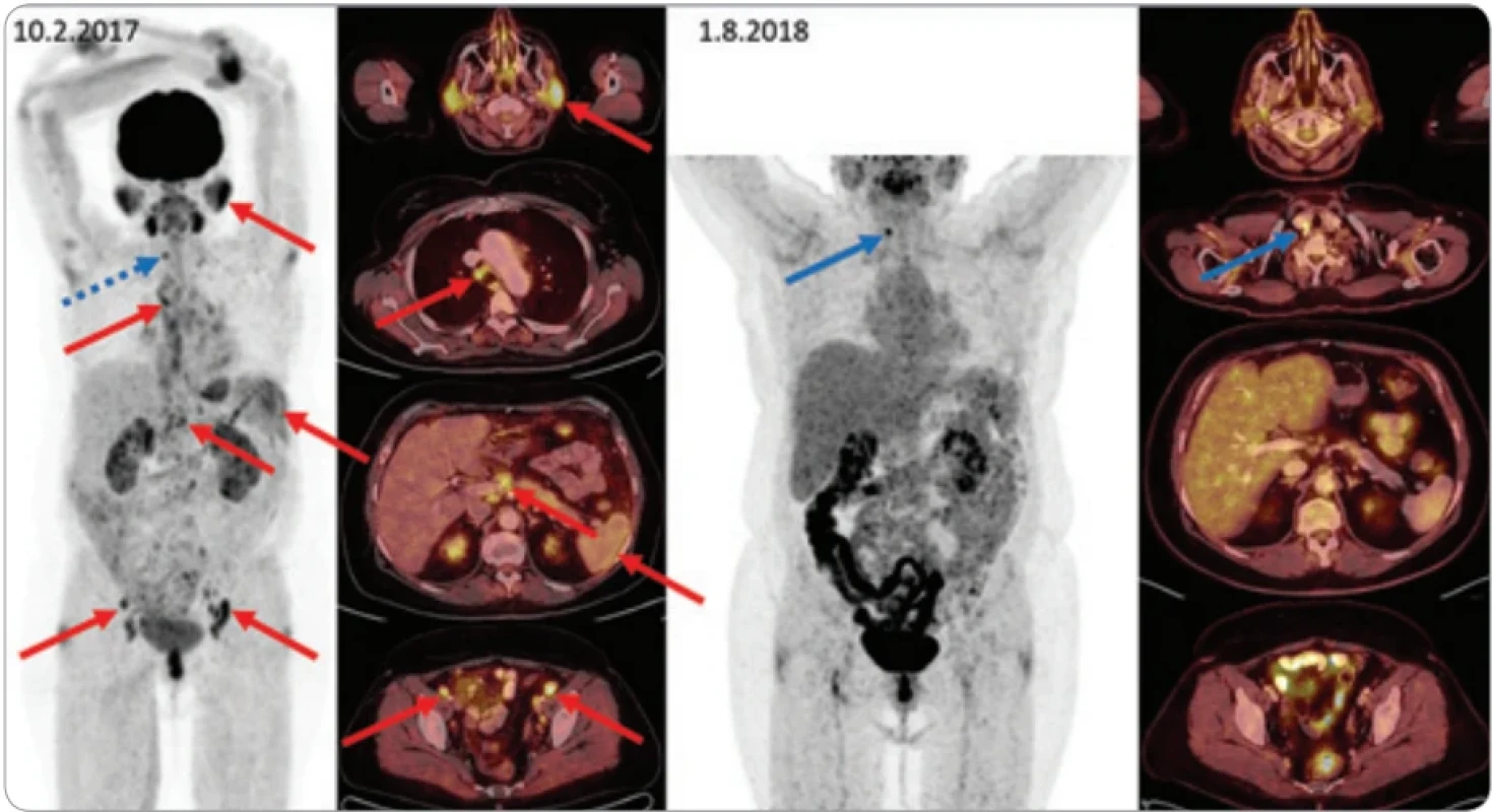 Pacientce (ročník 1950) byla v roce 2014 diagnostikována chronická pankreatitida (blíže typ pankreatitidy neupřesněn). V roce 2017 biopsie lymfadenopatie v třísle, histologicky stanovena IgG4-RD s vícečetnými ložisky, jak ukazují šipky. Modrá šipka ukazuje tumor ve štítné žláze. Strumektomie potvrdila papilární karcinom štítné žlázy. V roce 2017 byla podána léčba rituximabem a cyklofosfamidem a bylo dosaženo remise. V roce 2020 opakovaná léčba pro relaps nemoci a od té doby má pacientka udržovací léčbu rituximab 1 000 mg v 6měsíčních intervalech. Monitorace léčby pomocí 18F-FDG-PET/CT – vlevo iniciální sken (MIP PET snímané části těla a detaily v axiálních fúzovaných řezech), vpravo kontrolní sken. Šipkami jsou označeny metabolicky aktivní infiltrace příušních slinných žláz, zvětšená aktivní uzlina vpravo pod prsními svaly, infiltrace přechodu hlavy a těla pankreatu. Další méně výrazná ložiska (vlevo v gll. submandibularis, uzlinách na krku, kaudě pankreatu) jsou patrná na MIP zobrazení, ale nejsou označena. Tato metabolicky aktivní ložiska při kontrolním vyšetření zanikají, drobné reziduum bez zvýšené metabolické aktivity je patrné jen vpravo submamárně.