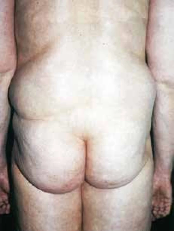 Lipomatosis benigna symetrica, tretí – gynekoidný typ panvového pletenca
