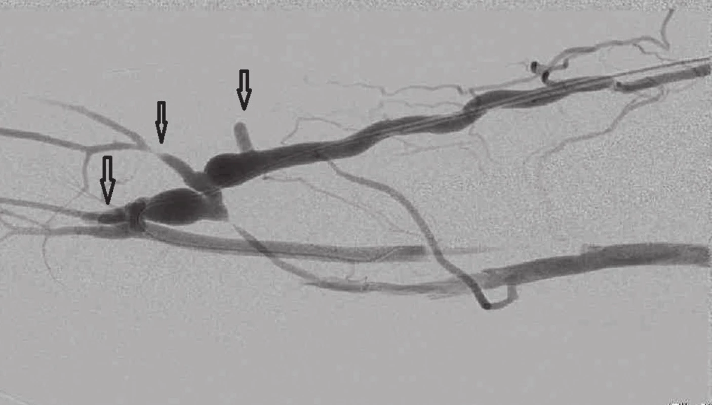 Fistulografie po podvazu 3 kolaterálních žil, šipky
Fig. 10: Fistulogram after ligation of 3 collateral veins; arrows