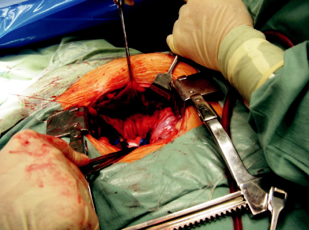 Intraperitoneální fenestrace objemné lymfokély otevřenou cestou
Fig. 5. Intraperitoneal fenestration of the large lymphocele using open surgery