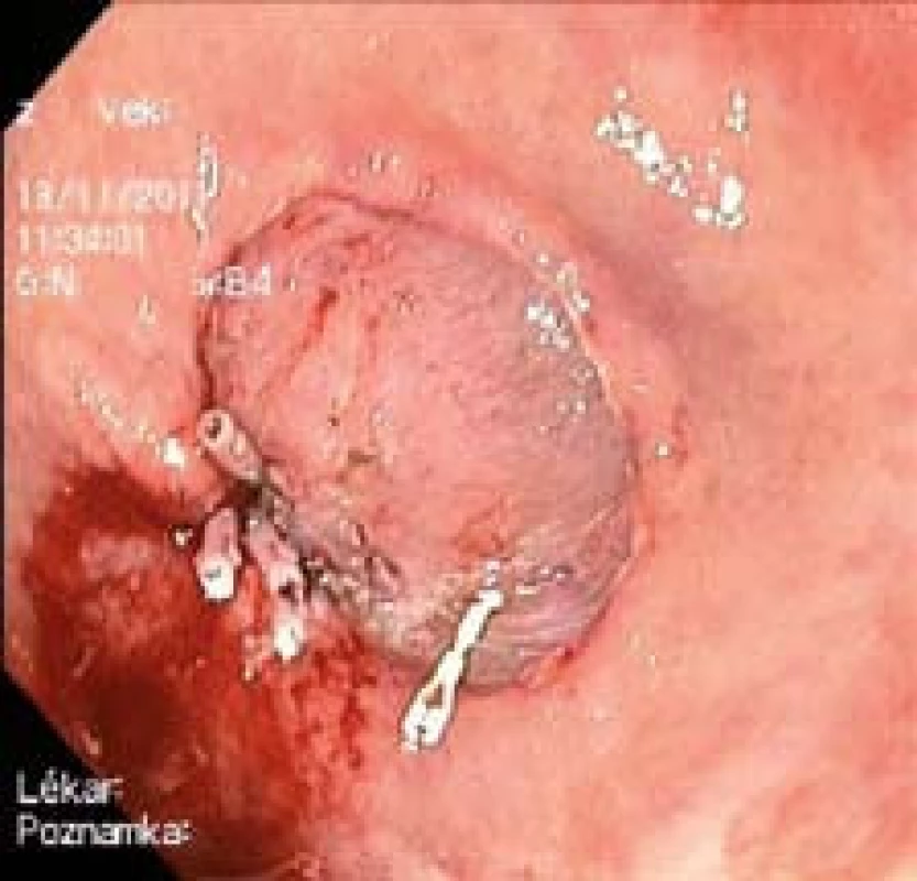 Spodina po ESD. Krvácení ošetřeno klipy.
Fig. 4. Undersurface following ESD. Bleeding stemmed through use of clips.