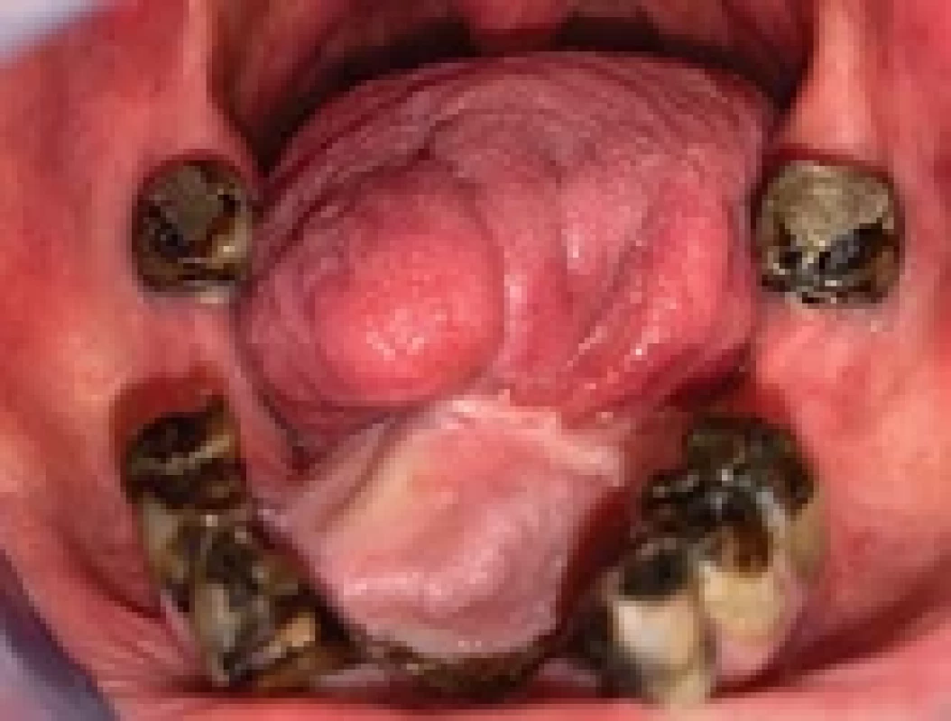 Reconstruction of the fl oor of the mouth with the radial forearm free fl ap.