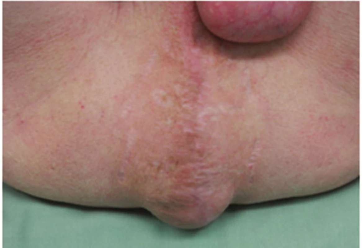 Perineální kýla
Fig. 1: Perineal hernia
