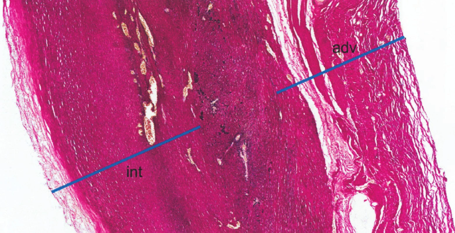 Histologie: Histotopogram resekované části stěny vzestupné aorty (barvení elastika – van Gieson). Stěna je výrazně ztluštělá, zejména fibrózním ztluštěním intimy (int) a adventicie (adv); mezi nimi je zjizvená, atrofická médie, s jen zbytky elastické složky (fragmenty černých hrubých vláken). Médie i intima jsou vaskularizované. Jde o obraz pozdního, jizevnatého stadia choroby, již bez nekróz a bez zánětlivých infiltrátů
Fig. 4. Histology: A histotopographic study of the resected part of the ascending aortic wall (elastic – van Gieson stain). The wall is significantly thickened, in particular due to fibrous intimal (int) and adventitial (adv) thickening; the inbetween media is scarred and atrophic, with remnants of the elastic component (fragments of black coarse fibres). The media and intima layers are vascularized. The above is a picture of late, scarring disease stage, already without necroses and inflammatory infiltrations