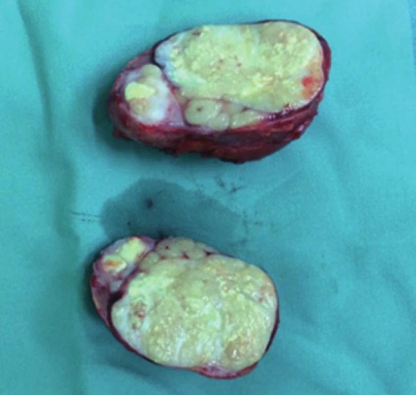 Lymfatická metastáza primárního tumoru
Fig. 6: Lymphatic metastasis of the primary tumour