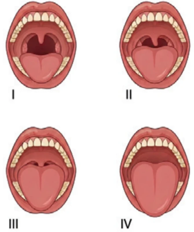 Mallampatiho klasifi kace. Fig. 2. Mallampati classifi cation. 