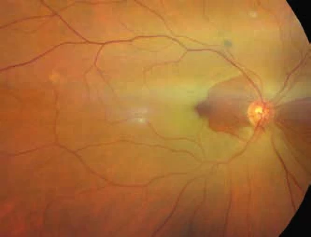 Okluze centrální retinální arterie – bělavý ischemický edém sítnice na očním pozadí. Central retinal artery occlusion – ischemic retinal oedema observed on fundus imaging.