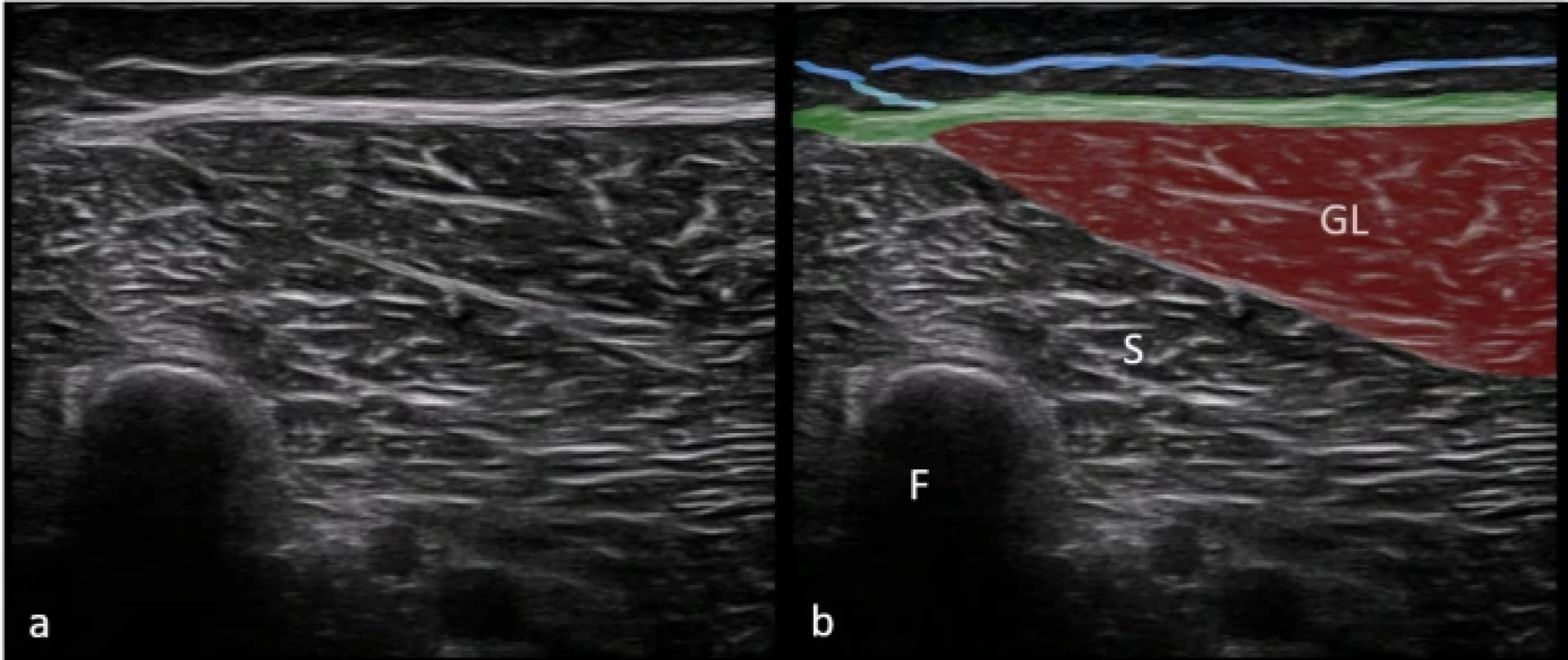  Zobrazení fascia cruris v lokalizaci posterior 2 na nativním sonografickém snímku (a) a na barevně zvýrazněném sonografickém snímku (b). Superficiální fascie je znázorněna modrou linií. Hluboká fascie (zelená linie) přechází přes GL. Retinacula cutis profundus jsou znázorněna světle modrou barvou. Fig. 11. Imaging of the crural fascia in the posterior 2 location in the original ultrasound image (a) and in a color-enhanced ultrasound image (b). The superficial fascia is represented by a blue line. The deep fascia is represented by a green line over the lateral belly of the GL. Retinacula cutis profundus are shown in light blue. 
