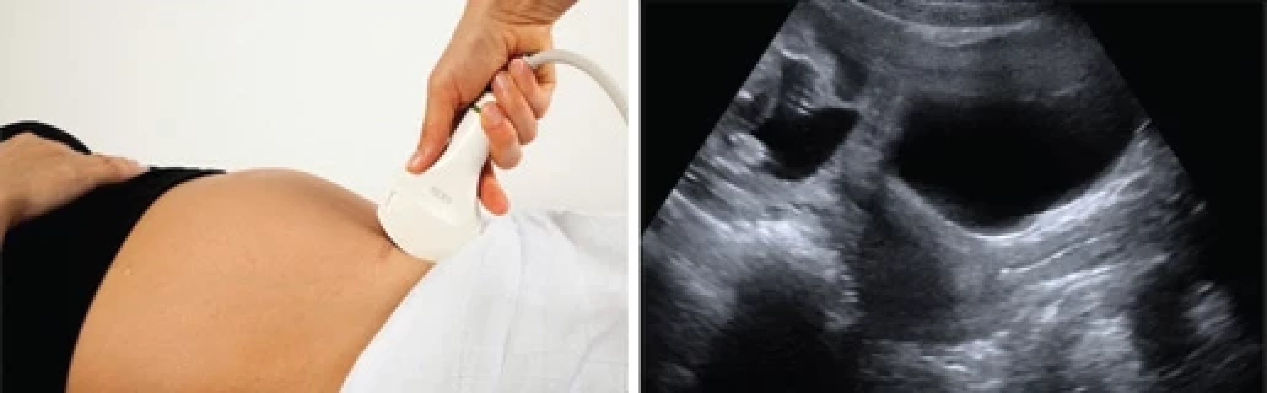 Probe placement and bladder base visualization at the time of transabdominal ultrasound.