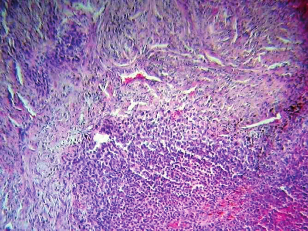 Histologický preparát sleziny: centrálne prítomná metastáza malígneho melanómu prevažne guľatobunkovej cytologickej výbavy