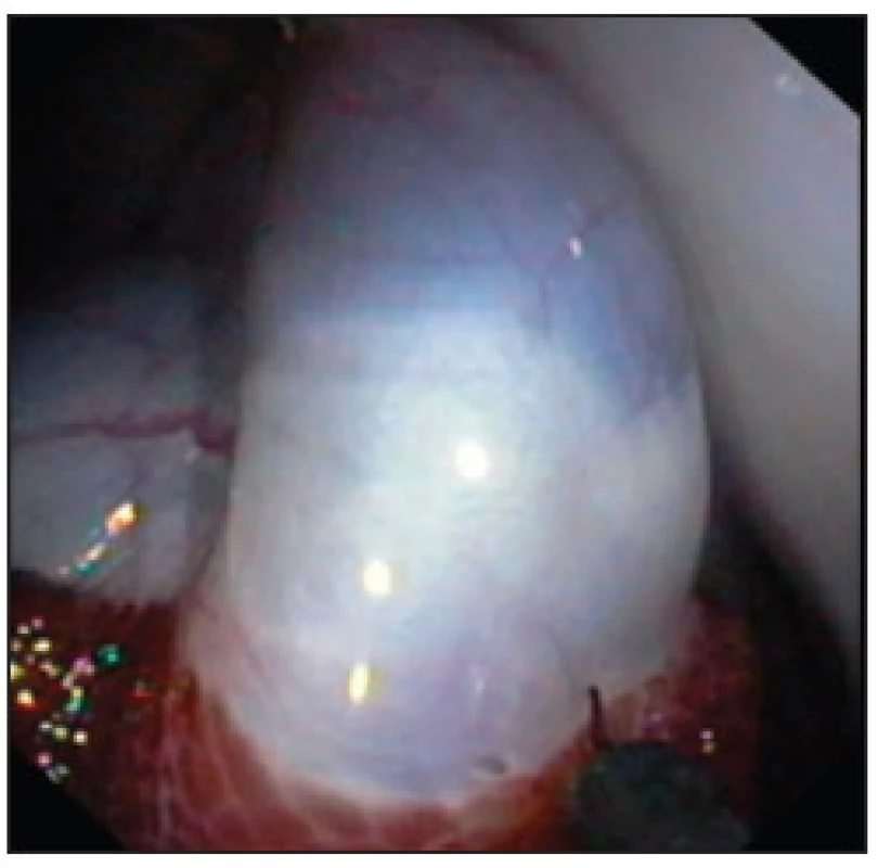 Disekce žlučníku z lůžka pomocí hook knife po podpichu fyziologickým roztokem 
Fig. 3. Dissection of the gall bladder after saline injection
