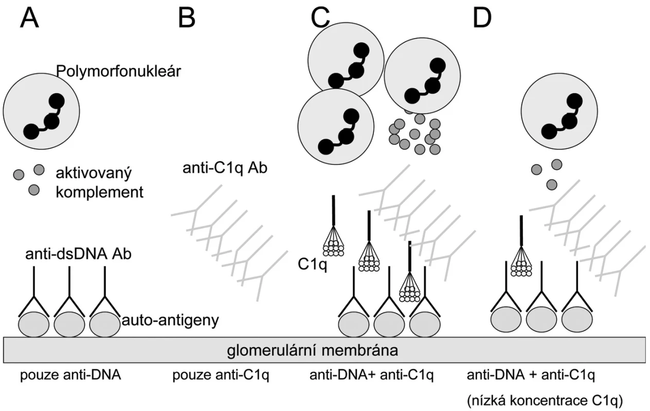 Hypotéza: Rozvine se lupusová nefritida či nikoliv? A) Pacienti s anti-ds DNA protilátkami
(anti dsDNA- dsDNA imunokomplexy) a bez anti-C1q protilátek mají mírnou a/nebo regulátory
komplementového systému efektivně kontrolovanou lupusovou nefritidu. 
B) Nemocní pouze s anti-C1q protilátkami nebudou mít renální postižení, protože to vyžaduje přítomnost protilátek proti klasickým lupusovým antigenům v glomerulu. 
C) Nemocní s anti-dsDNA protilátkami v glomerulu a vysokými titry anti-C1q protilátek budou mít těžkou lupusovou nefritidu díky zesílení aktivace zánětu prostřednictvím klasické cesty a influxu zánětlivých buněk. 
D) pacienti s anti-dsDNA protilátkami a anti-C1q protilátkami nemusí (zatím) mít lupusovou
nefritidu, pokud jsou lokální koncentrace C1q nízké a nedosahují prahu aktivace komplementu.
Upraveno dle Fliermana (45).