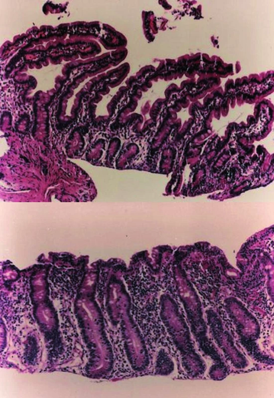 V horní části normální histologický obraz sliznice tenkého střeva. V dolní části obraz atrofické sliznice při celiakii.