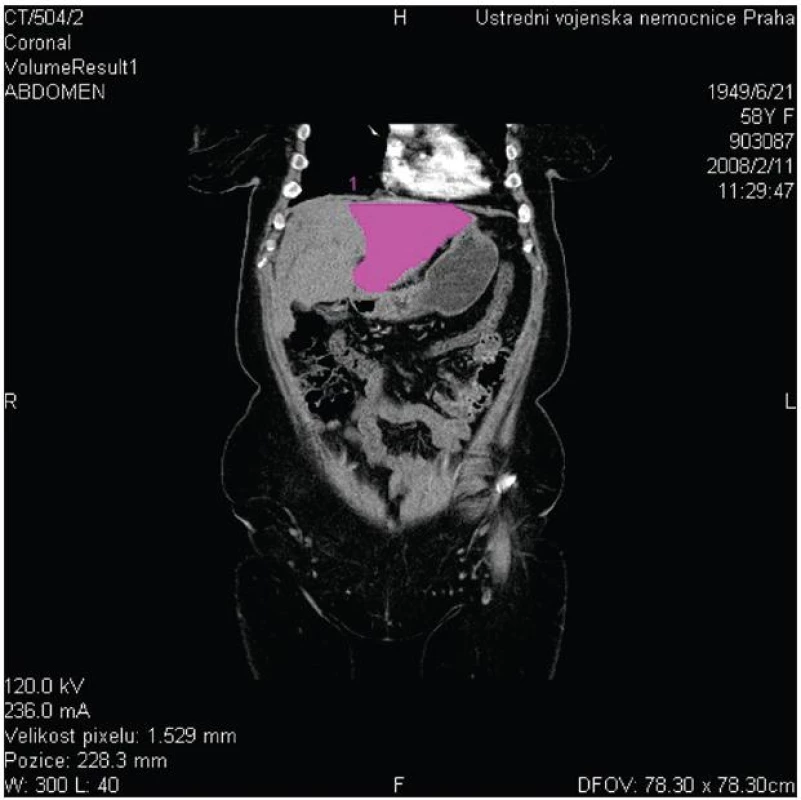 CT volumetrie s měřením objemu levého jaterního laloku
Fig. 5: CT volumetry of the left liver lobe