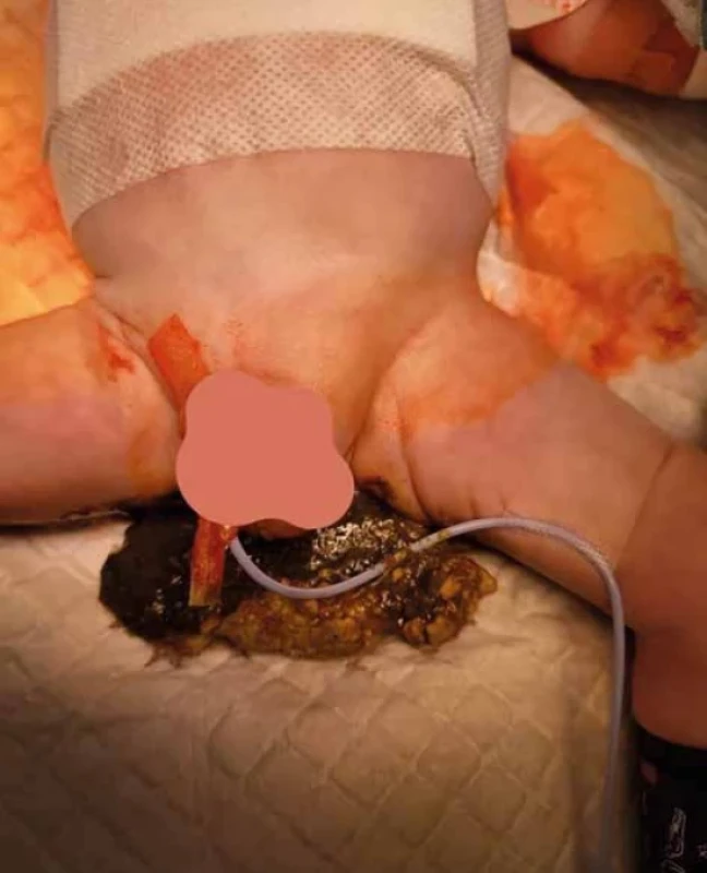 Perioperačný nález, laktobezoár