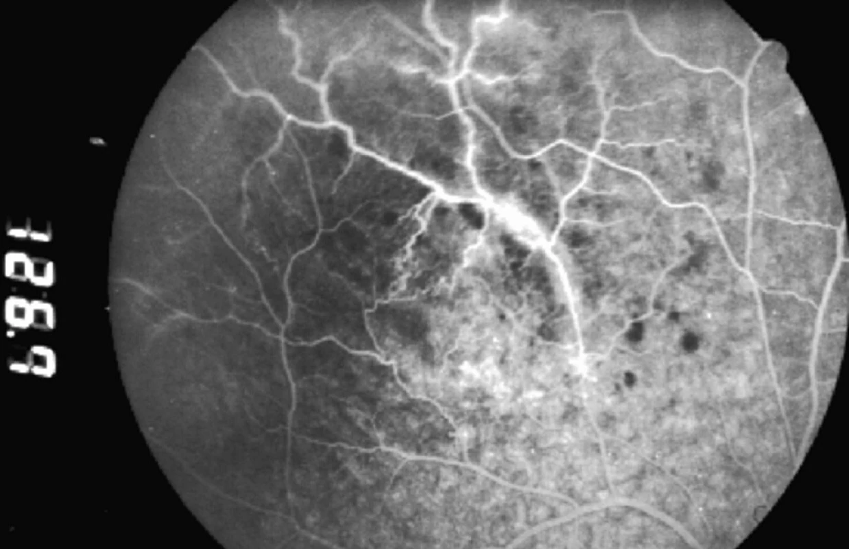 Fluoresceínová angiografia z 22. 3. 2004: a. v. shunty, a v neskorších fázach angiografie presakovanie farbiva z postihnutých ciev do okolitej sietnice