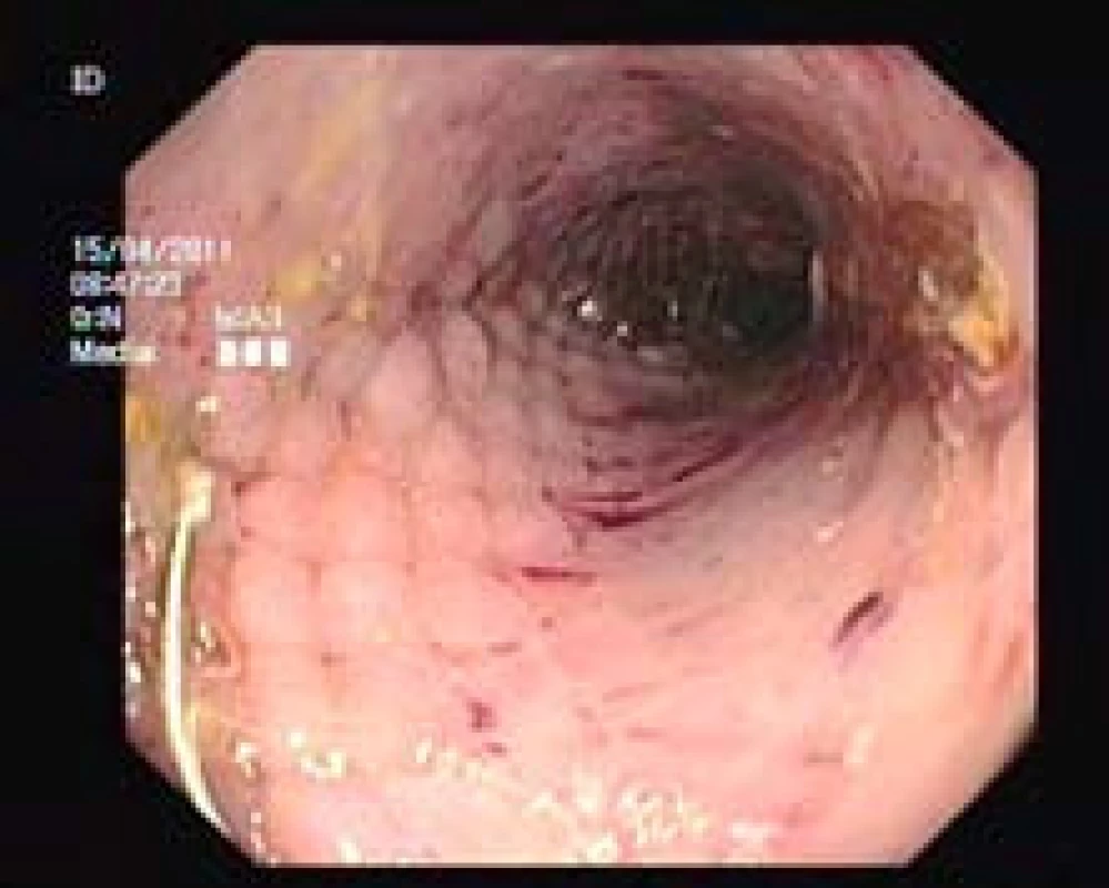 Endoskopický obraz rozvinutého stentu.
Fig. 2. Endoscopic image of developed stent.
