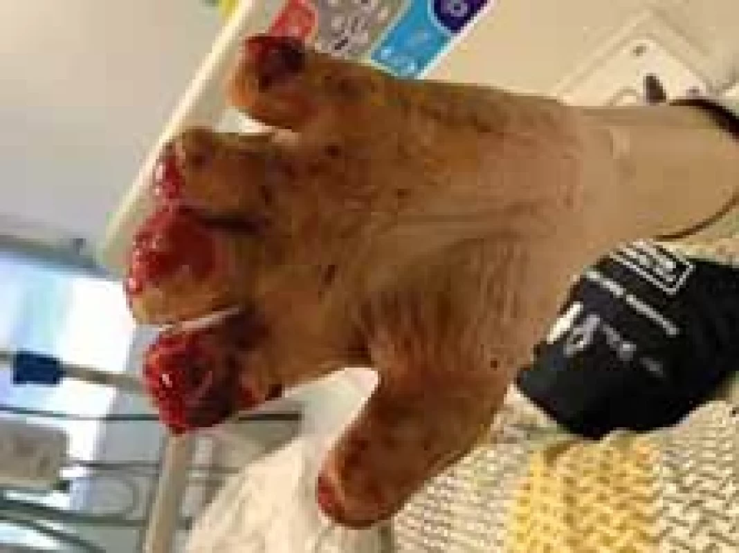 Appearance of left hand after operation (palm view).