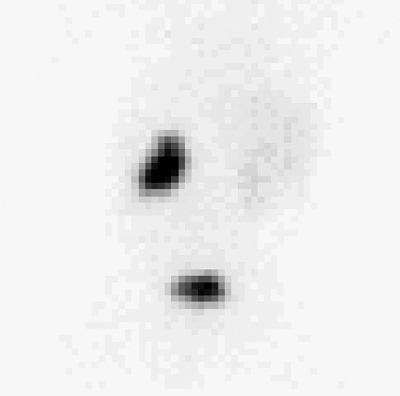 Kontrolní scintigram po skončení studie a po vymočení s výraznou retencí aktivity v dutém systému levé ledviny.
Fig. 9. A control scintigraphy after the end of the study and after micturition with a marked retention of activity in the hollow system of the left kidney.