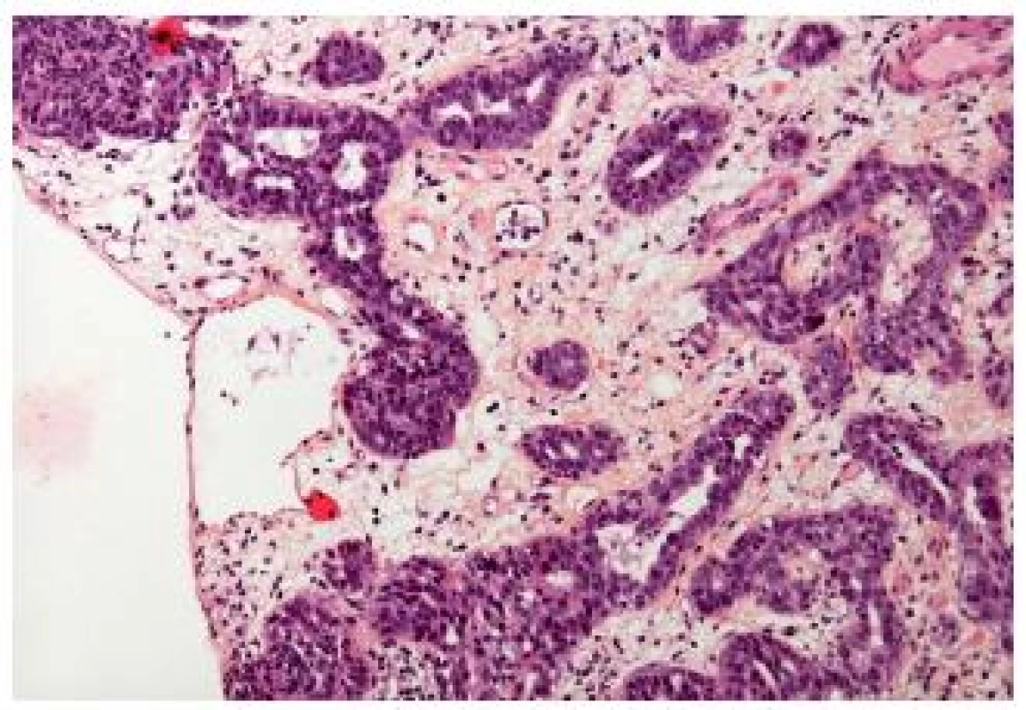 Small tubular type with few atypia, the stroma is edematous.