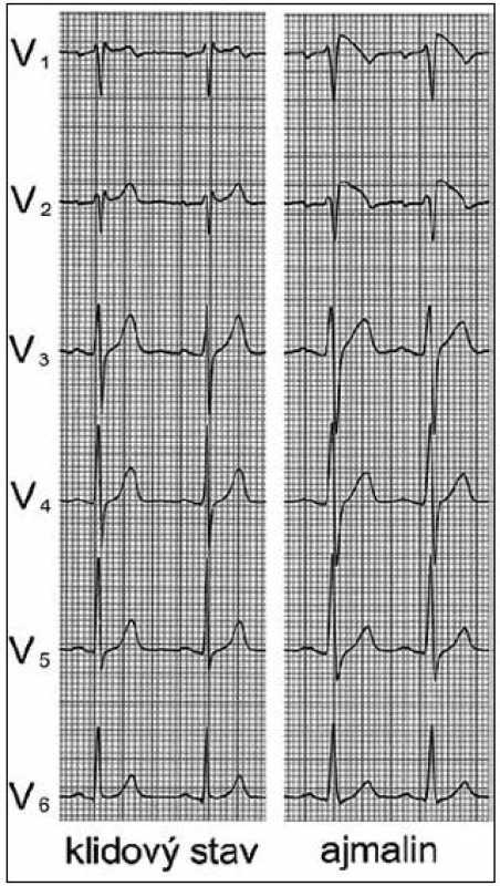 Ukázkové EKG pacienta se sedlovitým uspořádáním elevace ST ve svodech V<sub>1</sub> a V<sub>2</sub> v klidovém stavu, které se po aplikaci ajmalinu změnilo ve vyklenutý typ. S dovolením převzato z citace [73].