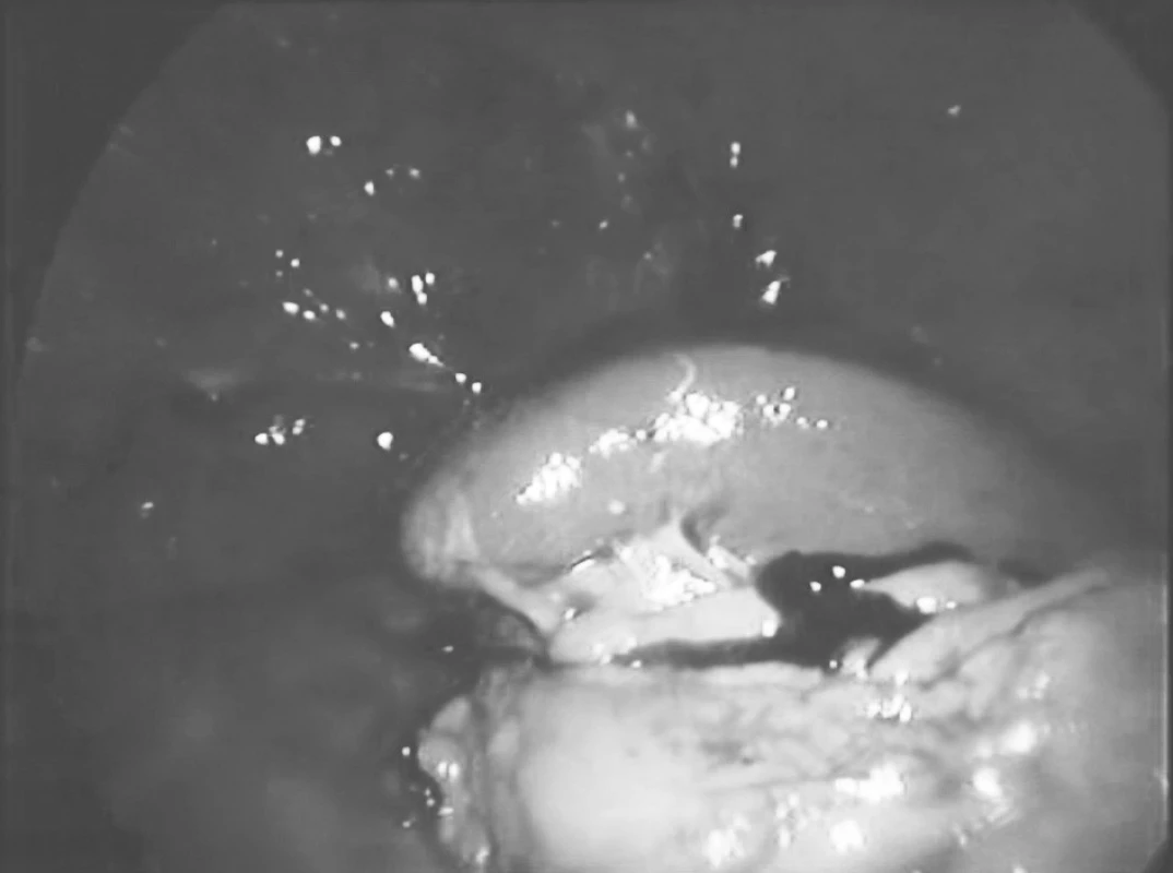 Preparát cysty sleziny