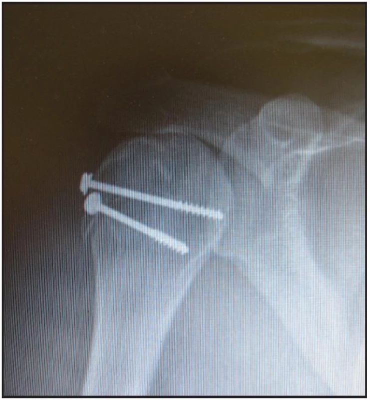 Miniosteosyntéza proximálního humeru