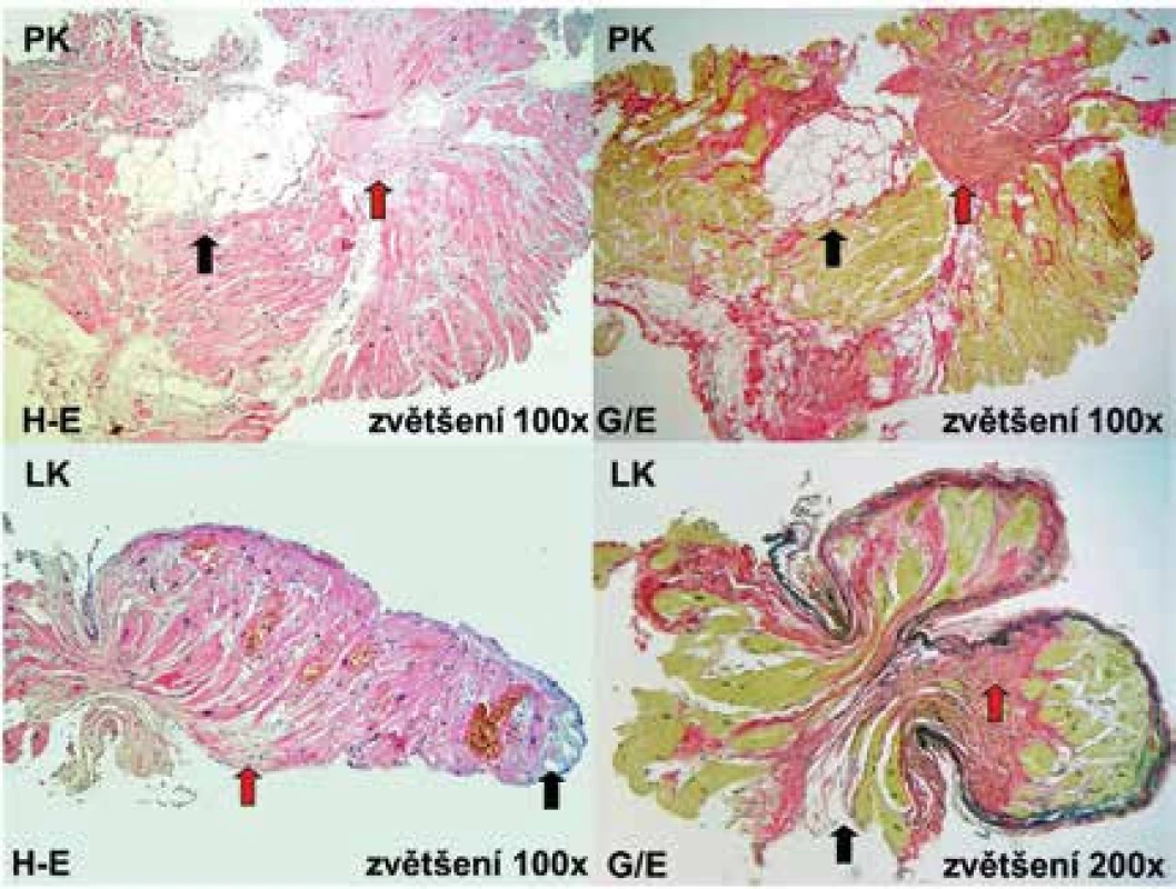 Histologické nálezy u pacienta s arytmogenní kardiomyopatií levé komory odebrané 
z postižené mezikomorové přepážky