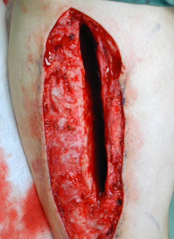 Stav po provedení rozsáhlého debridement měkkých tkání a trepanaci tibie žlábkem 1 cm širokým a 12 cm dlouhým umožňujícím provedení debridement dutiny diafýzy tibie