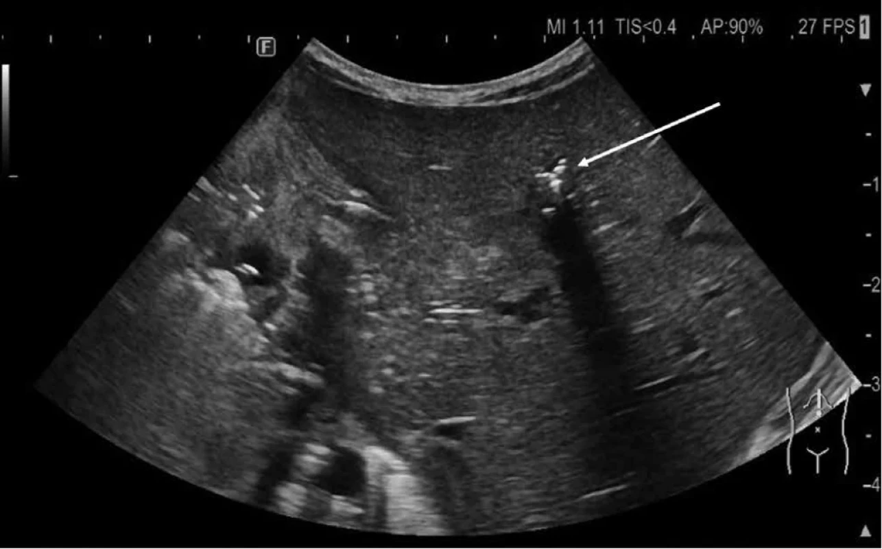 Sonografický obraz portálneho venózneho plynu. Šípka ukazuje na prítomnosť bubliniek plynu v portálnych vetvách v pečeni, ktoré sa zobrazujú ako hyperechogénne body a vytvárajú vetviaci obraz. Bublinky plynu sú pohyblivé a v dynamickom USG obraze vytvárajú „sparkling“ efekt (z archívu Neonatologickej kliniky JLF UK a UNM).