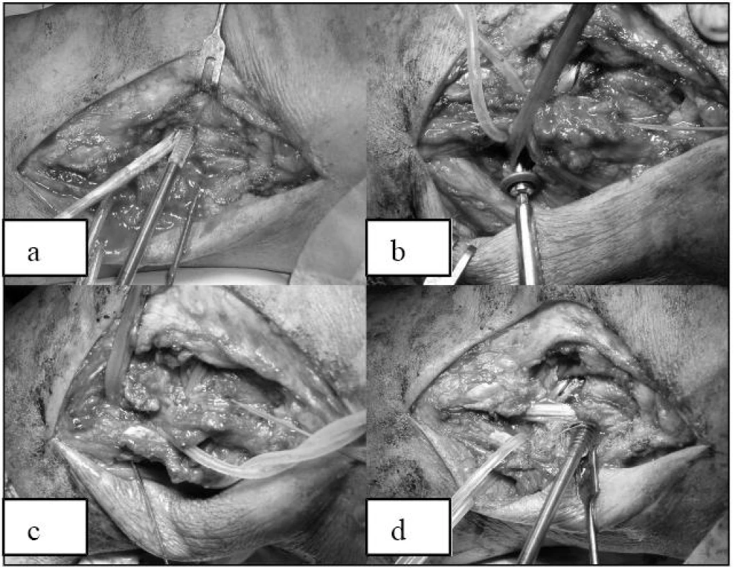 (a) Fixace štěpu v místě původního úponu šlachy m. popliteus interferenčním šroubem. (b) Jištění kolem šroubu s hrotnatou podložkou = rekonstrukce m. popliteus (c) Protažení štěpu kanálem vrtaným v hlavičce a fixace titan. interfer. šroubem = rekonstrukce lig. popliteofibulare. (d) Tonizace a fixace ve valgozitě interferenčním šroubem = rekonstrukce ZPV