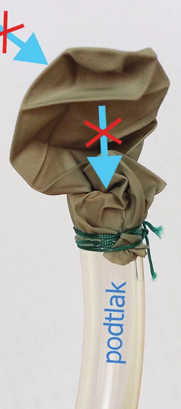 Princip funkce Heimlichovy chlopně a) výdech – vzduch uniká otvorem blízko vrcholu chlopně; b) nádech – podtlak způsobí kolaps chlopně, a tedy uzavření otvoru.
Fig. 3: Principle of the Heimlich valve a) expiration – air goes out through a small opening near the valve top, b) inspiration – the negative pressure causes the collapse of the valve and occlusion.