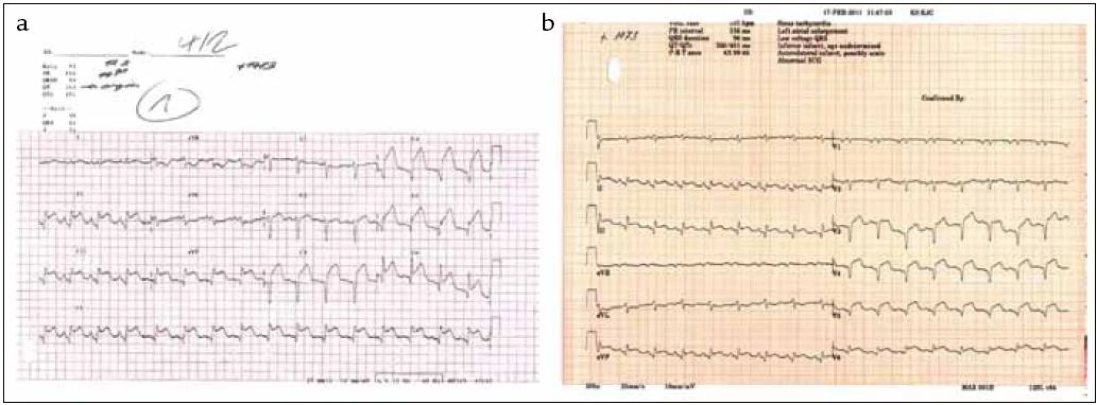 EKG se známkami akutního infarktu myokardu s QS a elevacemi ST úseku ve II, III, aVF, V<sub>2</sub>–V<sub>6</sub> při přijetí pacientky k hospitalizaci (a) s mírnou regresí nálezu při propuštění z nemocnice (b).