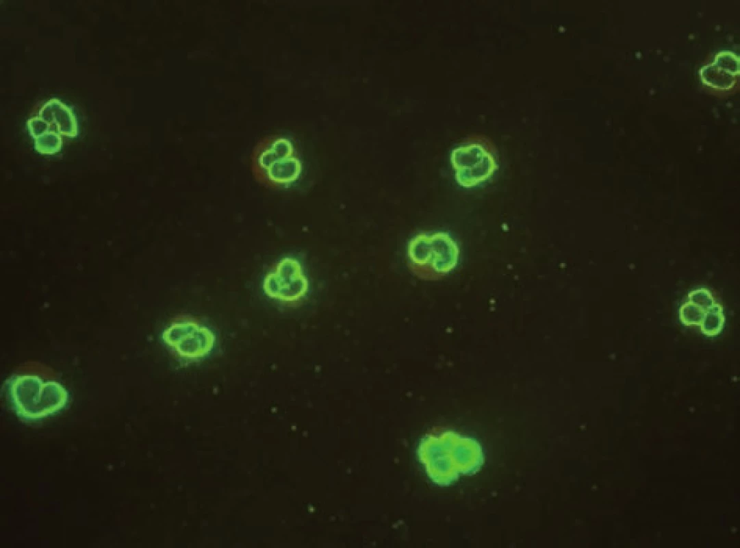 Imunofluorescenční obraz ANCA protilátek perinukleárního typu na lidských granulocytech fixovaných etanolem.
Fig. 4. Immunofluorescent image of anti-neutrophil cytoplasmatic antibodies of perinuclear type on human granulocytes fixed with ethanol.