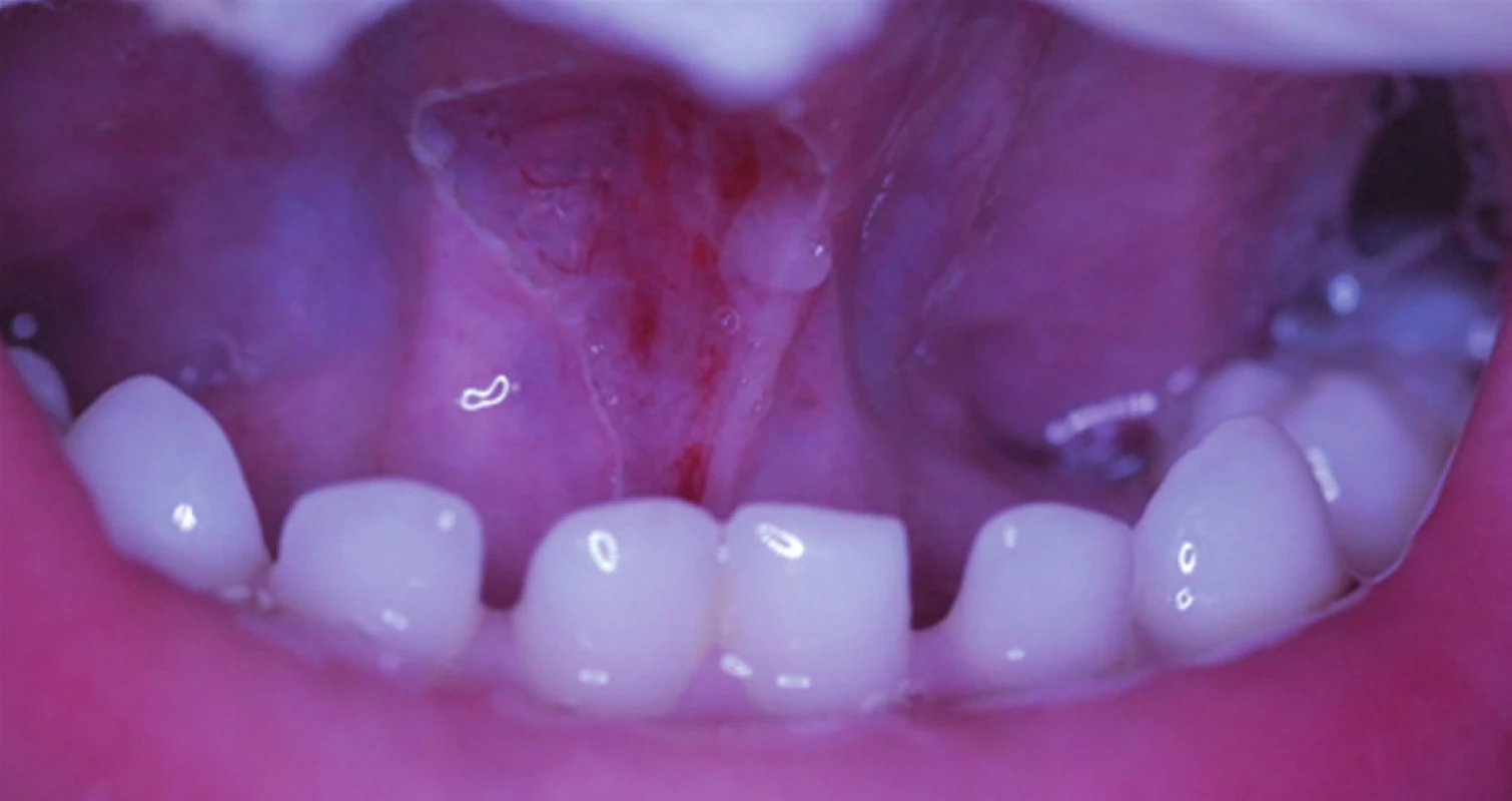 Stav po jazykové frenulotomii.
Fig. 2. Status after tongue frenulotomy.