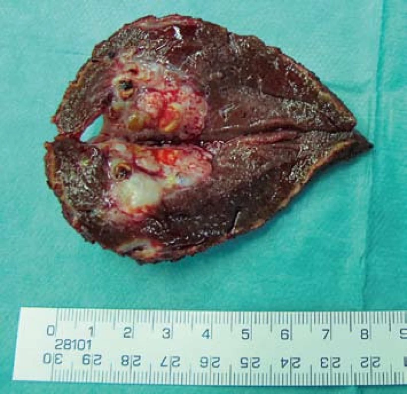 Preparát – resekát jater s HCC.
Fig. 2. Specimen – resected liver with HCC.
