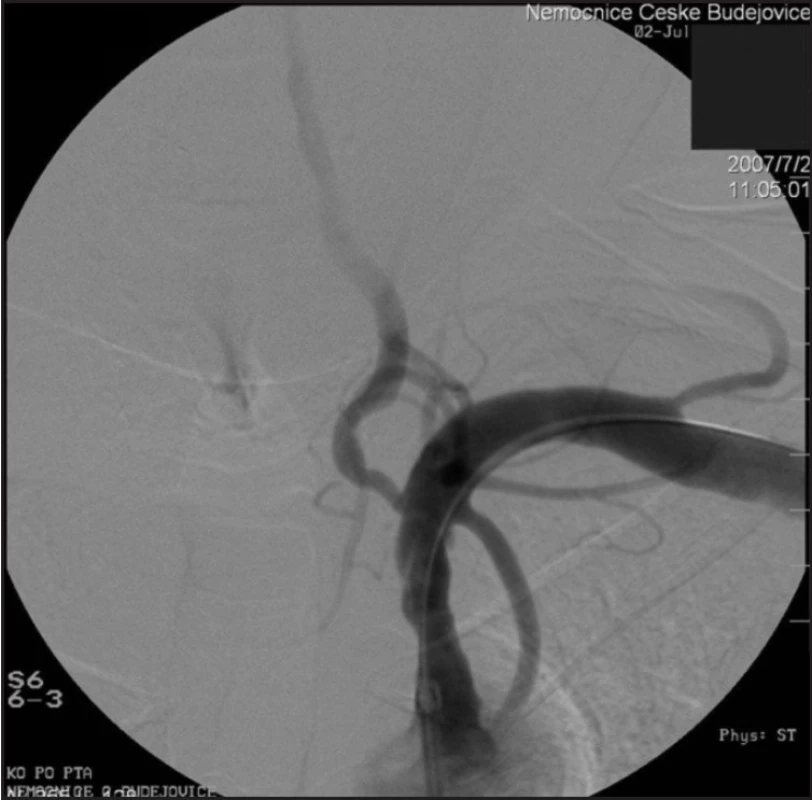 Angiografie: stenóza a. subclavia po PTA.