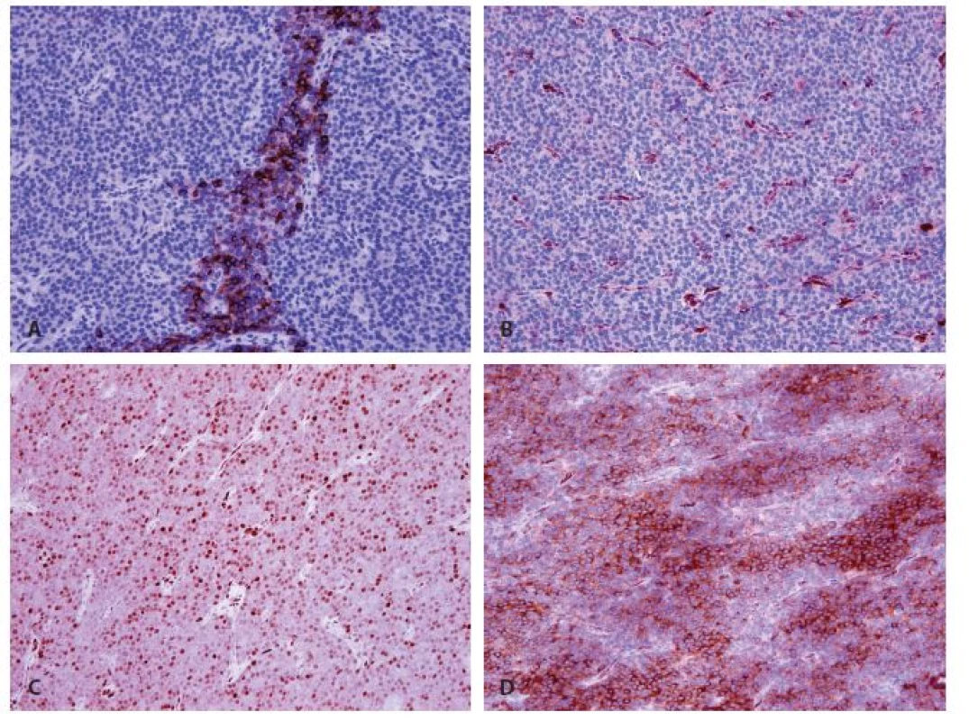 Immunohistochemical findings of parathyromatosis.
A: Focal strong cytoplasmic expression of parathormon (magnifications x 200).
B: Negativity of galectin 3 (magnifications x 200).
C: Nuclear weak or mild expression of cyclin D1 (magnifications x 200).
D: Strong difuse cytoplasmatic expression of chromogranin (magnifications x 200).