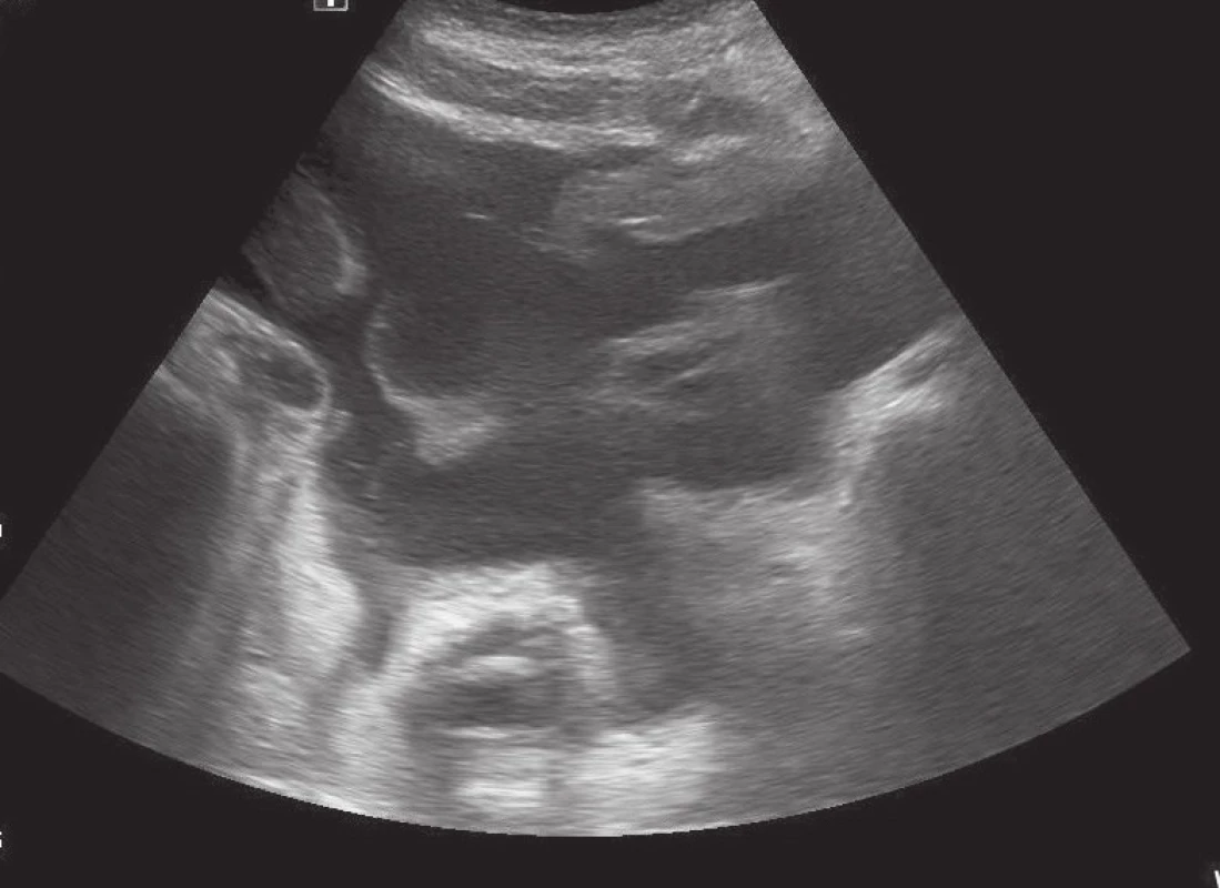 Ultrasonografický nález volné tekutiny v dutině břišní
Fig. 1: Ultrasonographic finding of loose fluid in the abdominal cavity