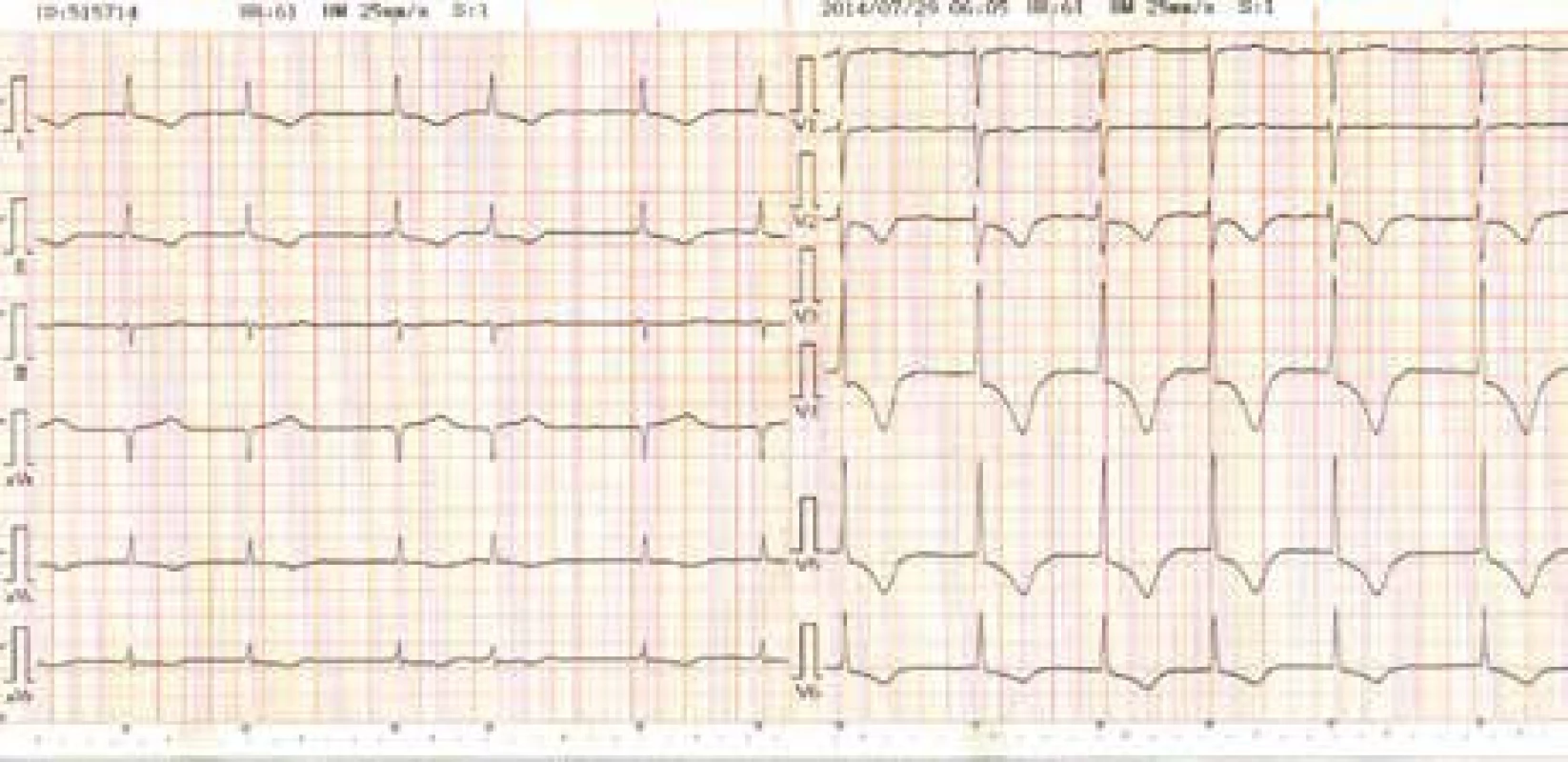 EKG 5. den hospitalizace