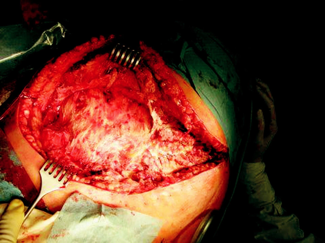 Operační nález
Obr. 1. Intraoperative findings